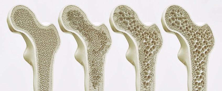 正常骨質（圖左）與骨質疏鬆（圖右）比較。